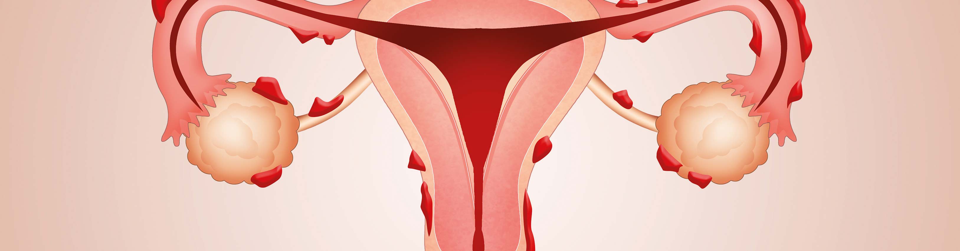 Endometriose - Rechtzeitig erkennen und gezielt behandeln